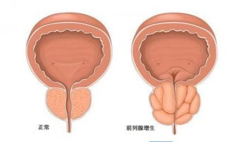 前列腺增生中期有什么症状