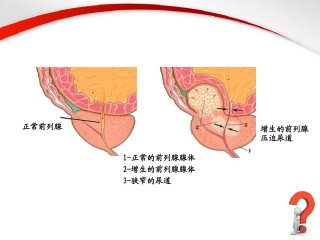 得了前列腺增生一般有哪些症状